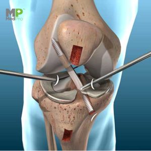 Knee Replacement Drape