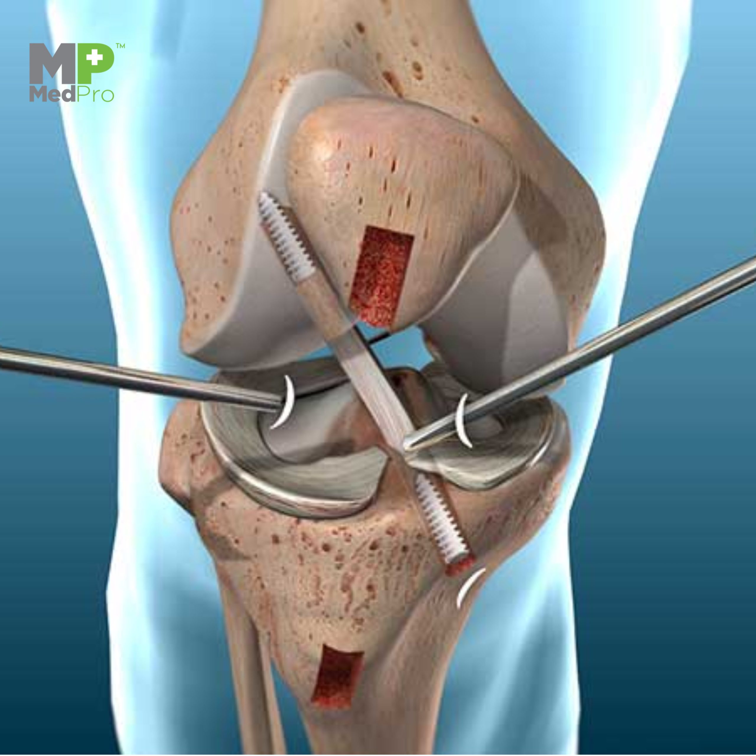 Knee Replacement Drape